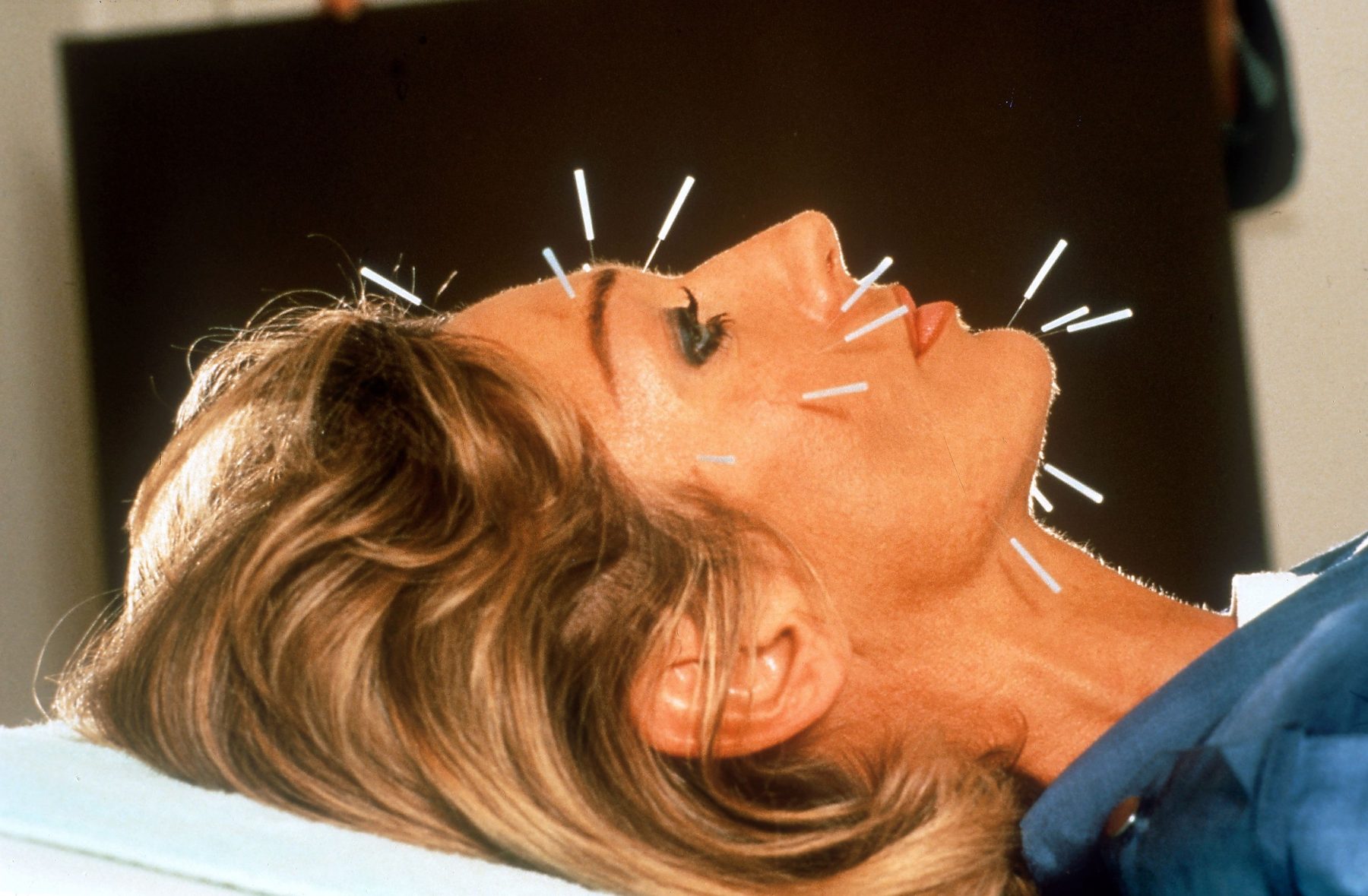 Как акупунктура помогла пережить heartbreak и отпустить прошлое